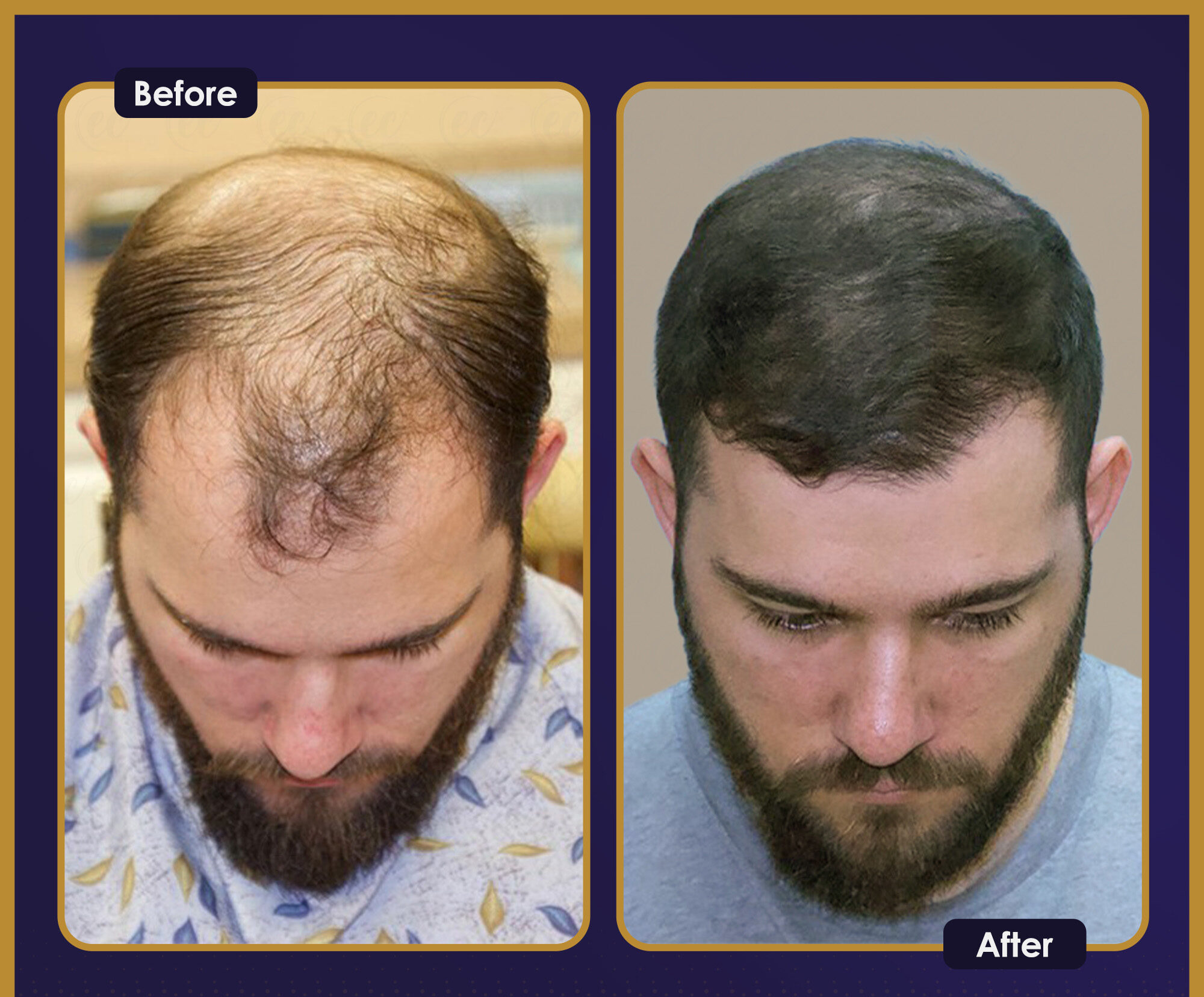 MJB Care hair transplant patient before and after result 1