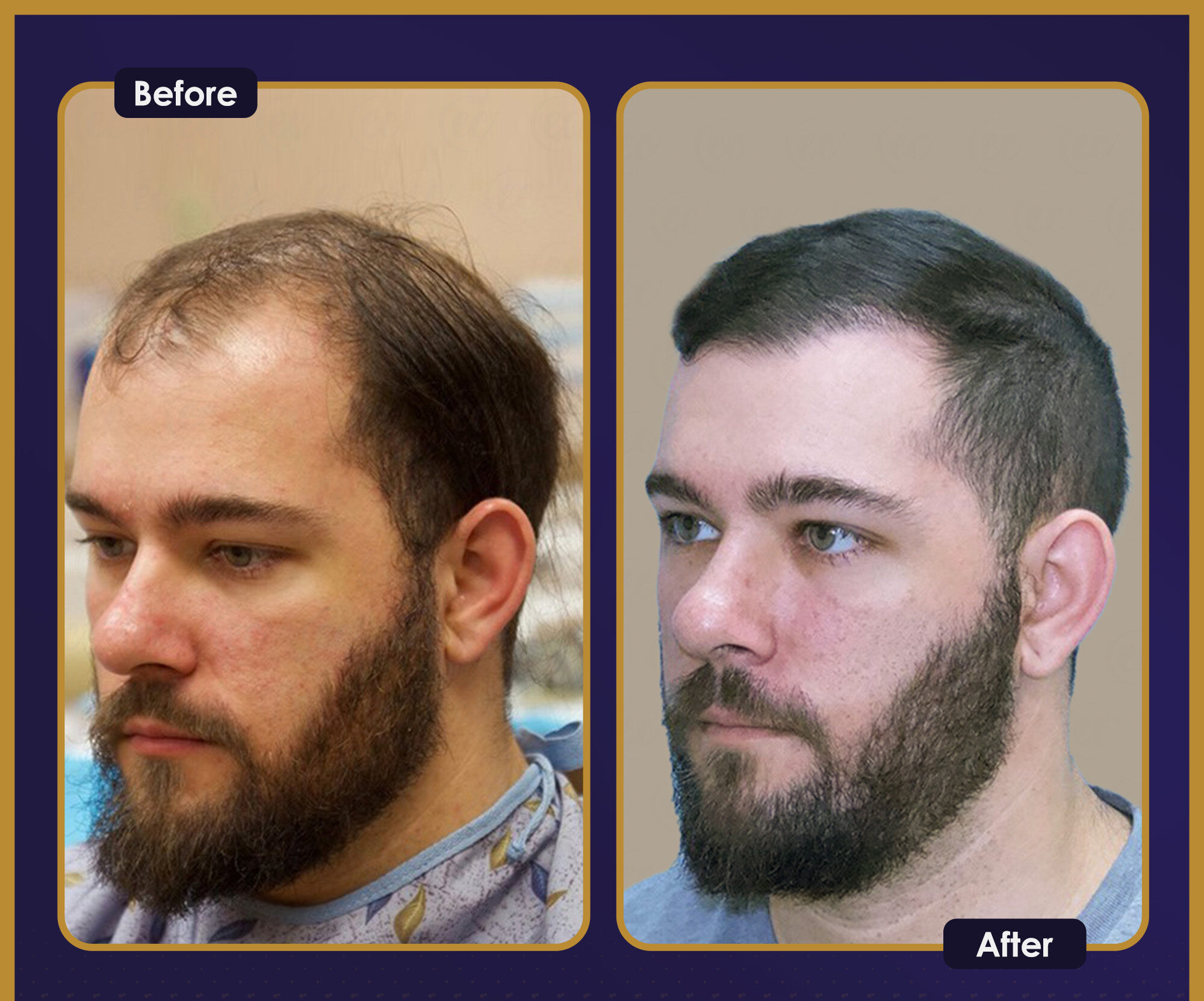 MJB Care hair transplant patient before and after result 2
