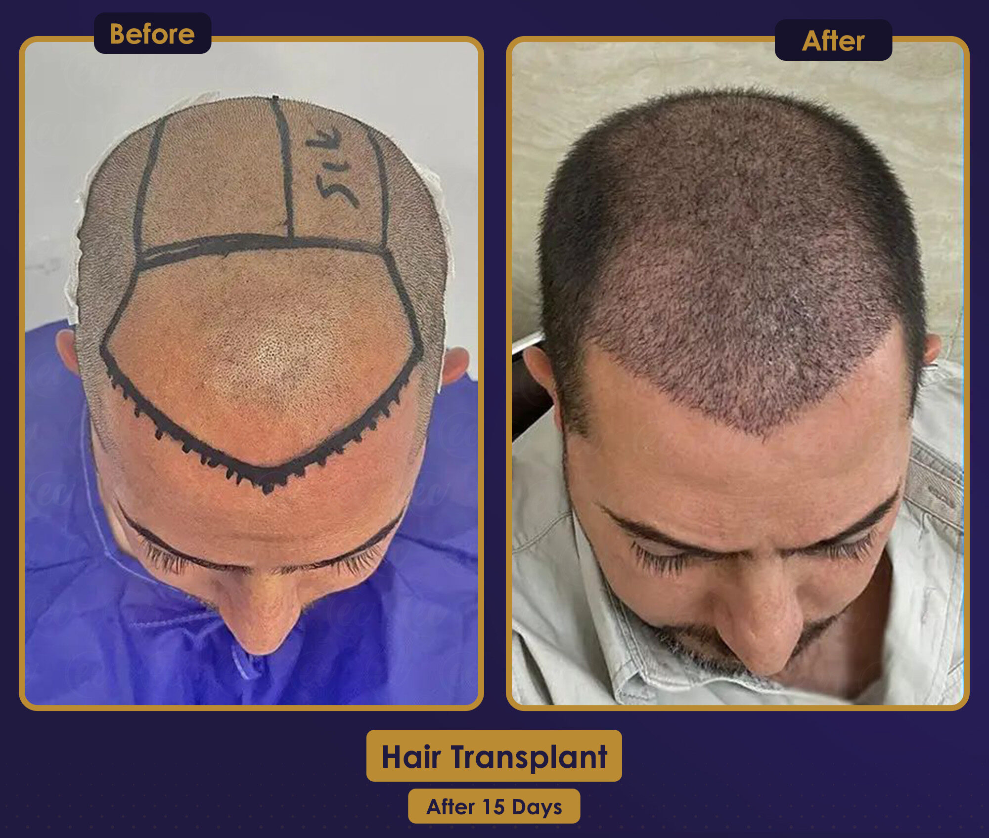 MJB Care hair transplant patient before and after result 3