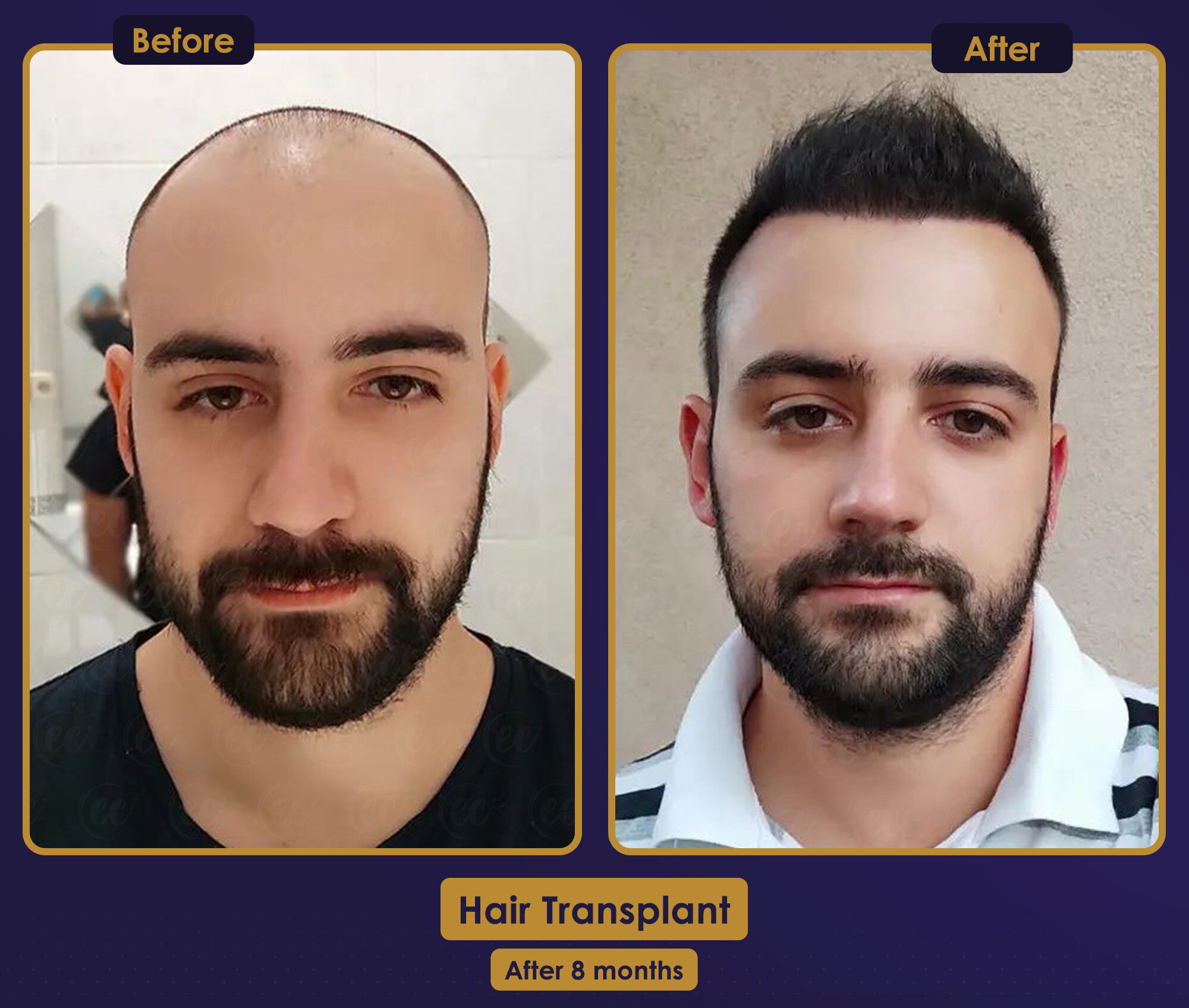 MJB Care hair transplant patient before and after result 4