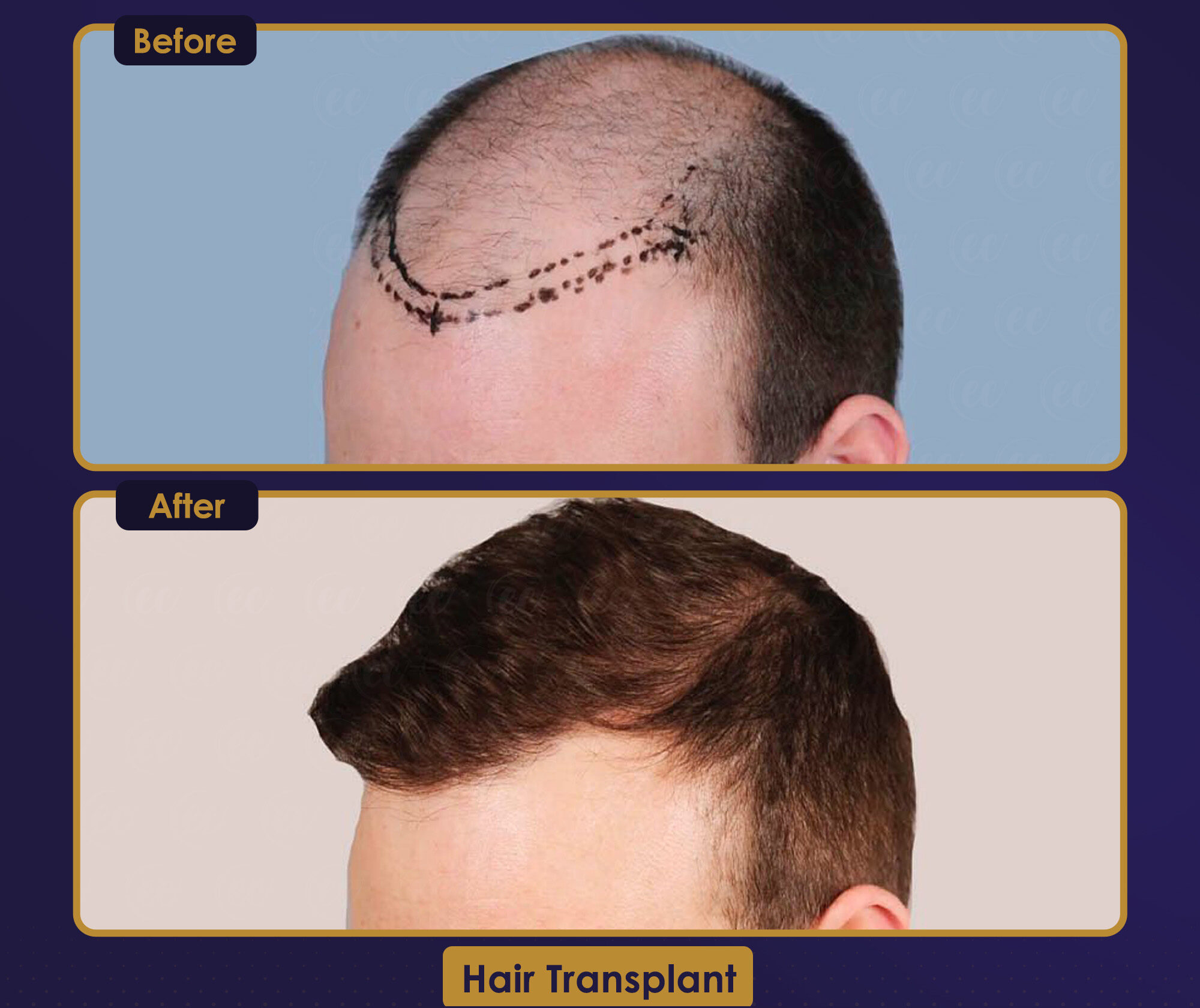 MJB Care hair transplant patient before and after result 5