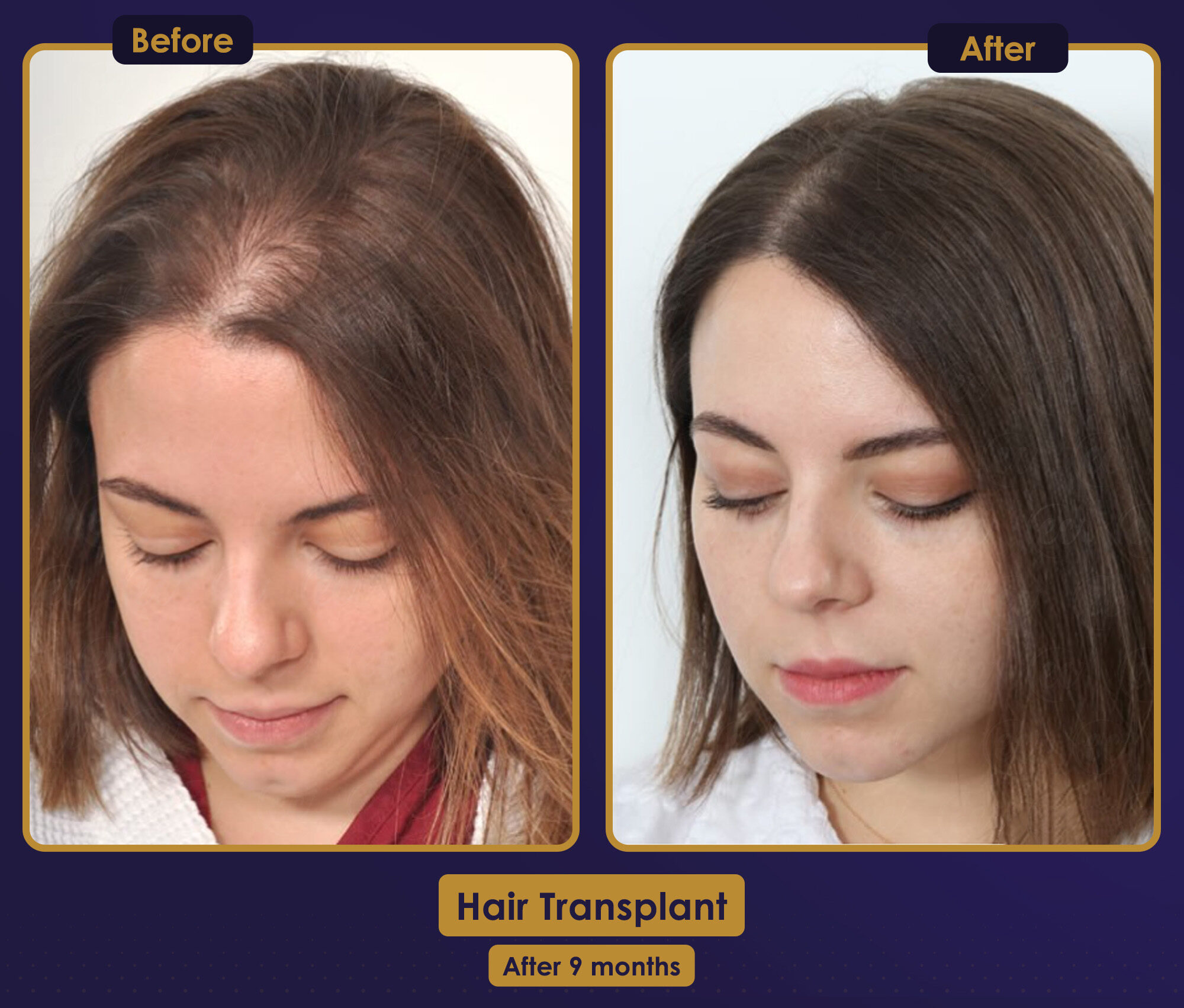 MJB Care hair transplant patient before and after result 6
