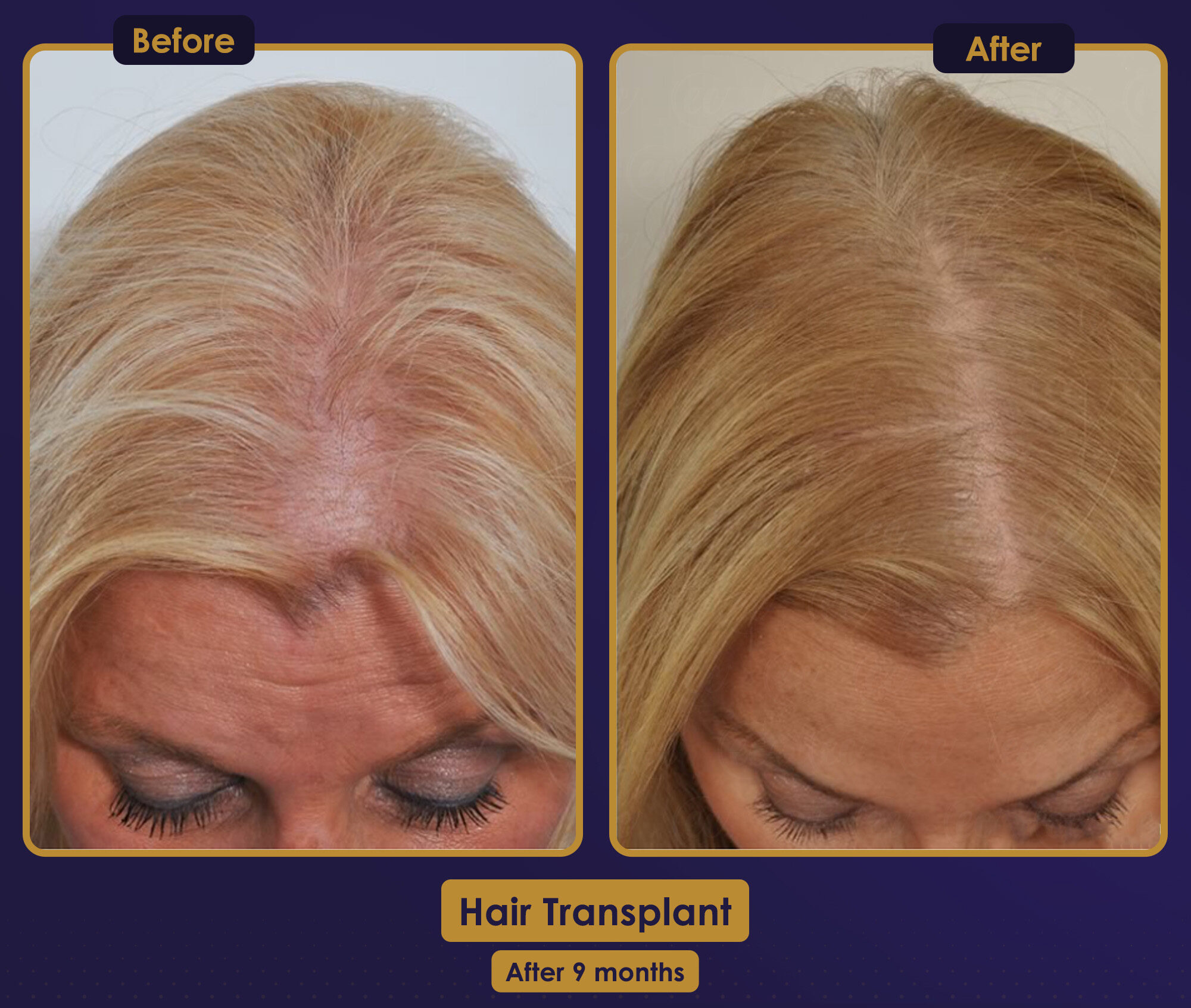 MJB Care hair transplant patient before and after result 7