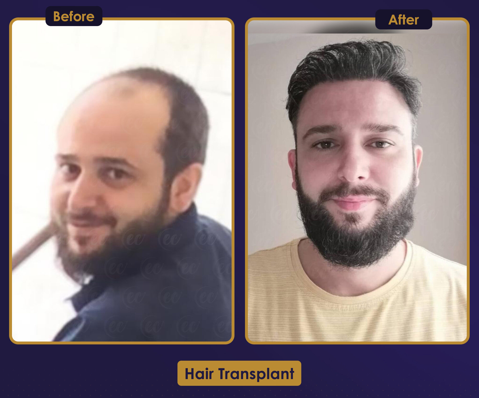 MJB Care hair transplant patient before and after result 8