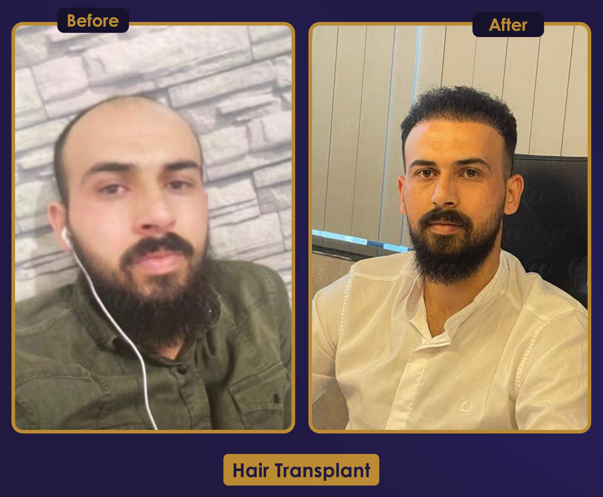 MJB Care hair transplant patient before and after result 9