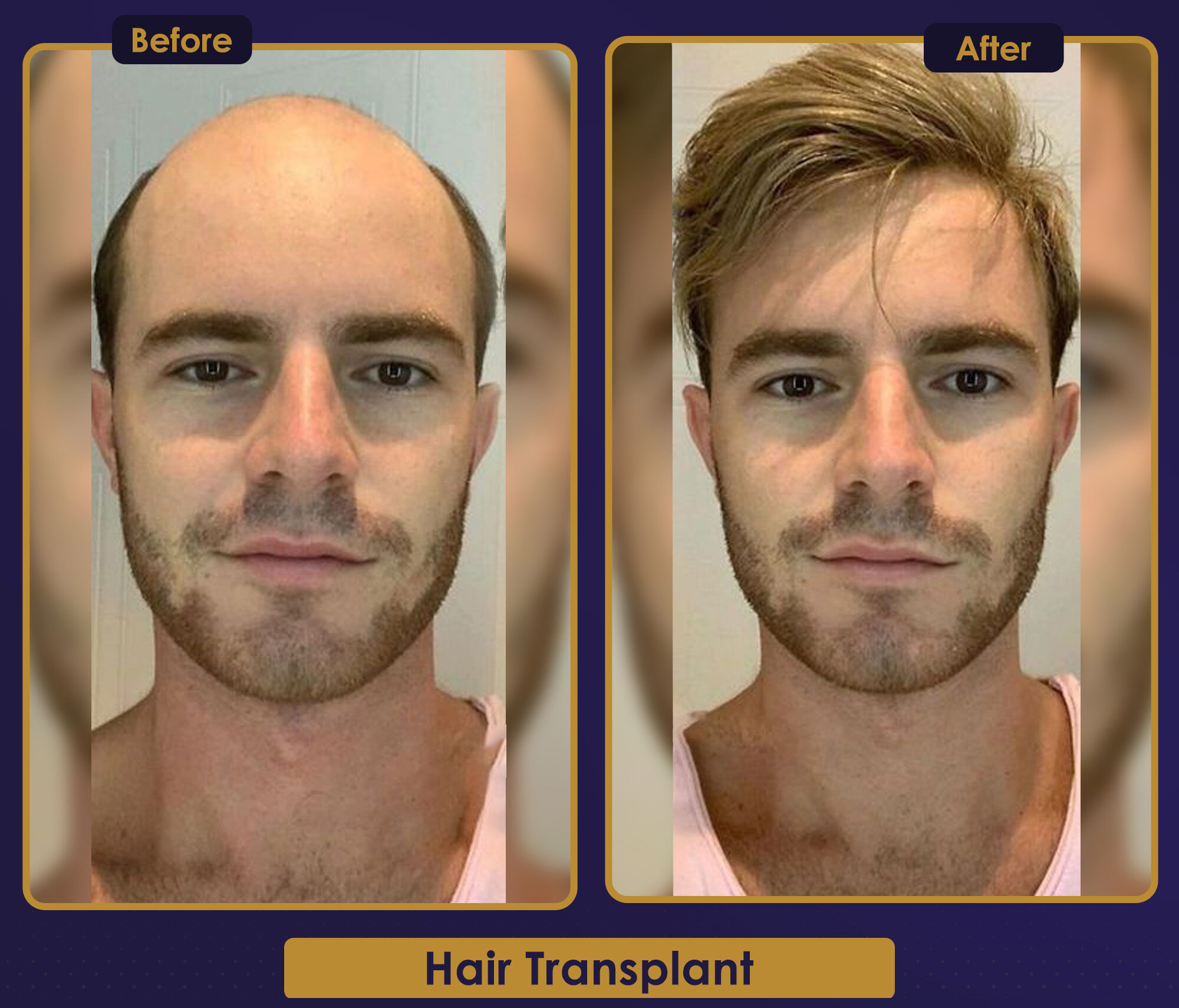 MJB Care hair transplant patient before and after result 10