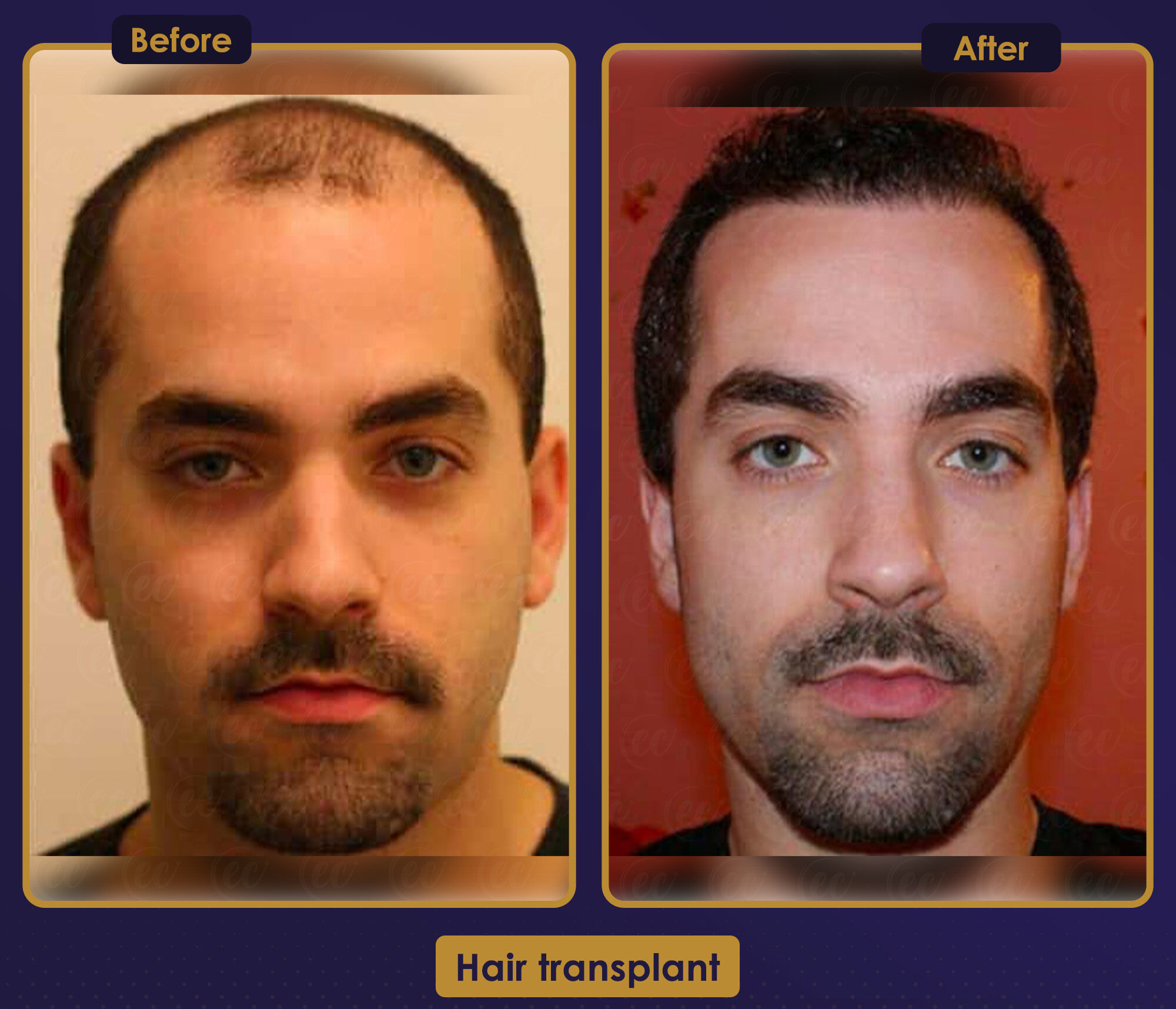 MJB Care hair transplant patient before and after result 11